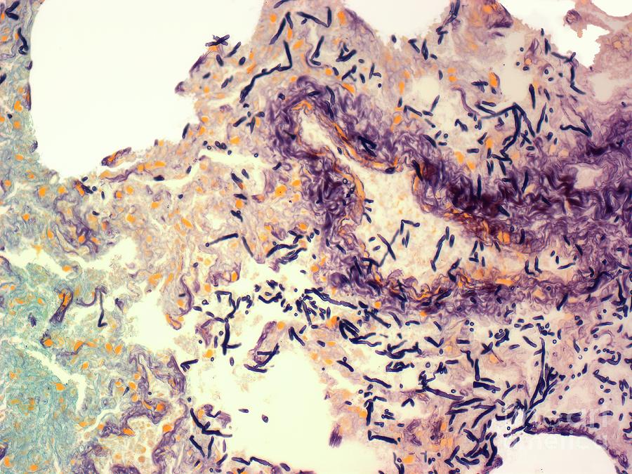 fungal-lung-infection-stock-image-m210-0262-science-photo-library