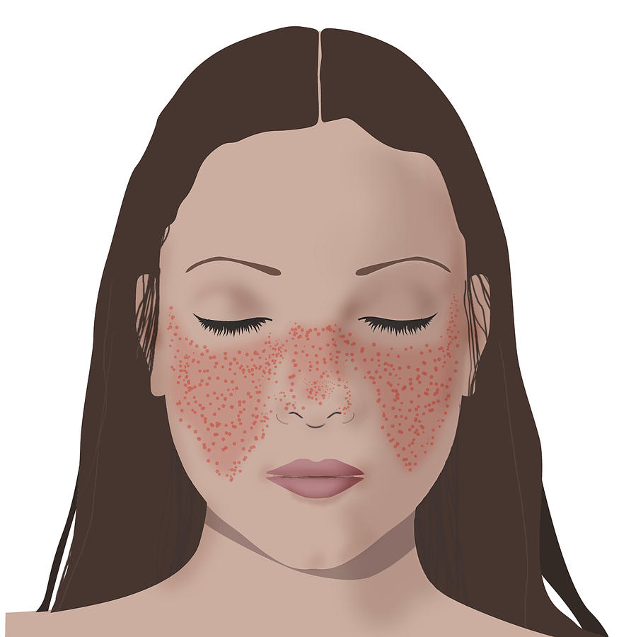 Lupus Rash On Womans Face Photograph by Monica Schroeder