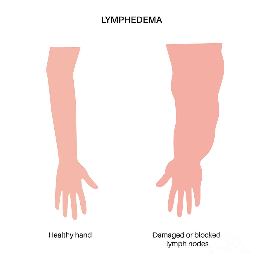 Lymphoedema Of Arm Photograph by Pikovit / Science Photo Library - Pixels