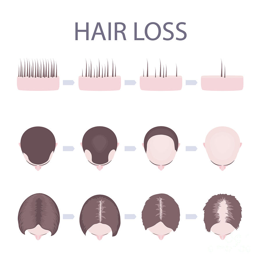 Male And Female Hair Loss Patterns Photograph by Art4stock/science ...