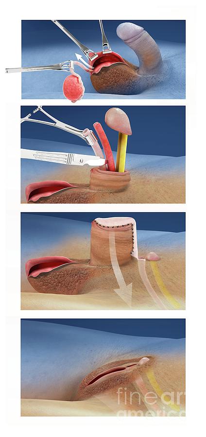 Male female Sex Change Operation Photograph by Claus Lunau science  