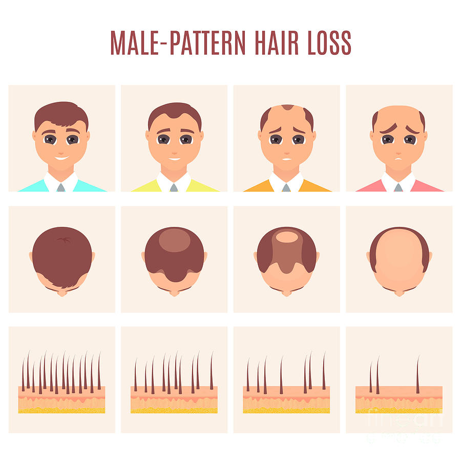 Male Pattern Hair Loss Photograph by Art4stock/science Photo Library ...