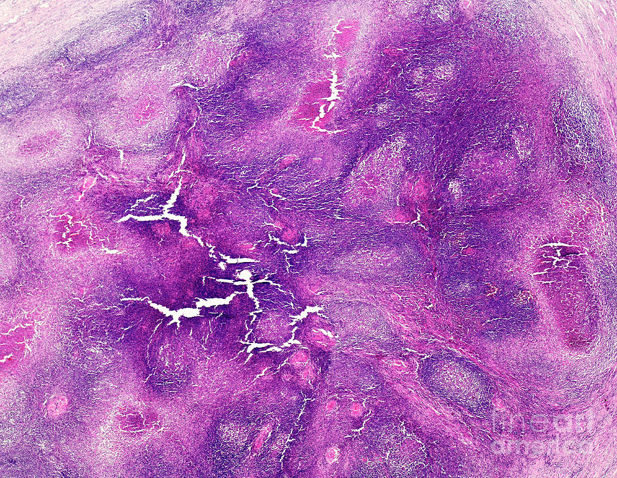 Malignant Lymphoma Photograph by Nigel Downer/science Photo Library