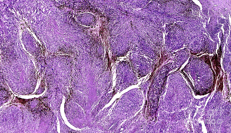Malignant Melanoma In Human Skin Photograph by Nigel Downer/science Photo Library
