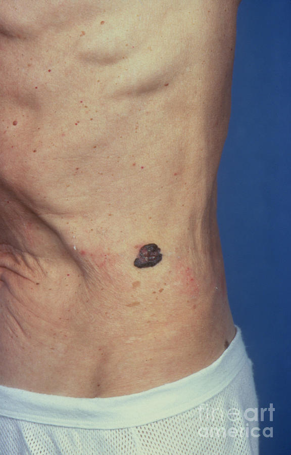 Malignant Melanoma Photograph by James Stevenson/science Photo Library
