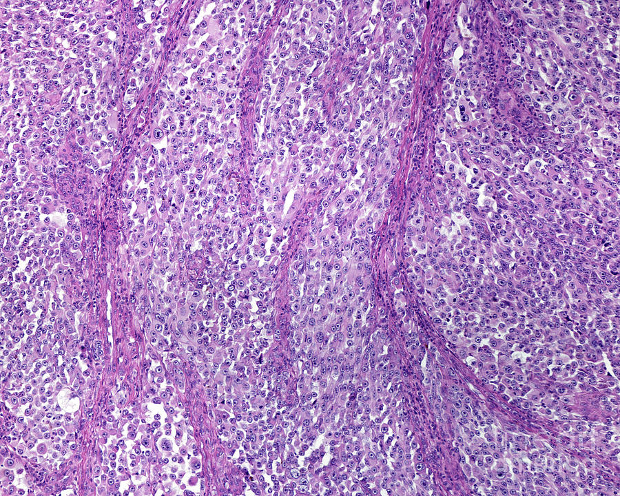 Malignant Melanoma Photograph by Jose Calvo / Science Photo Library