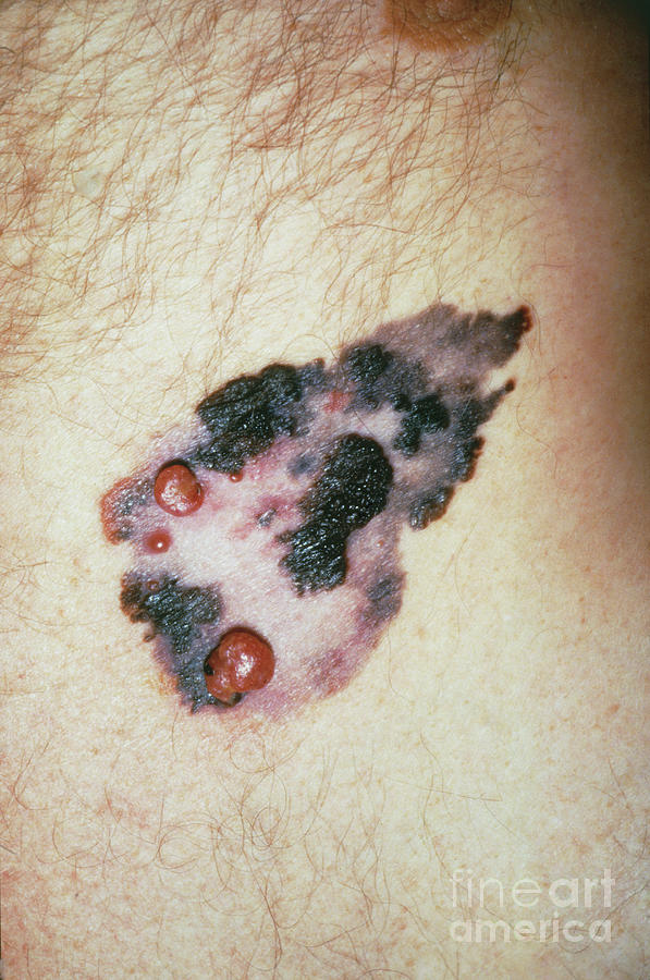Malignant Melanoma Of Chest Wall Of A Male Photograph by Kings College School Of Medicine, Department Of Surgery/science Photo Library