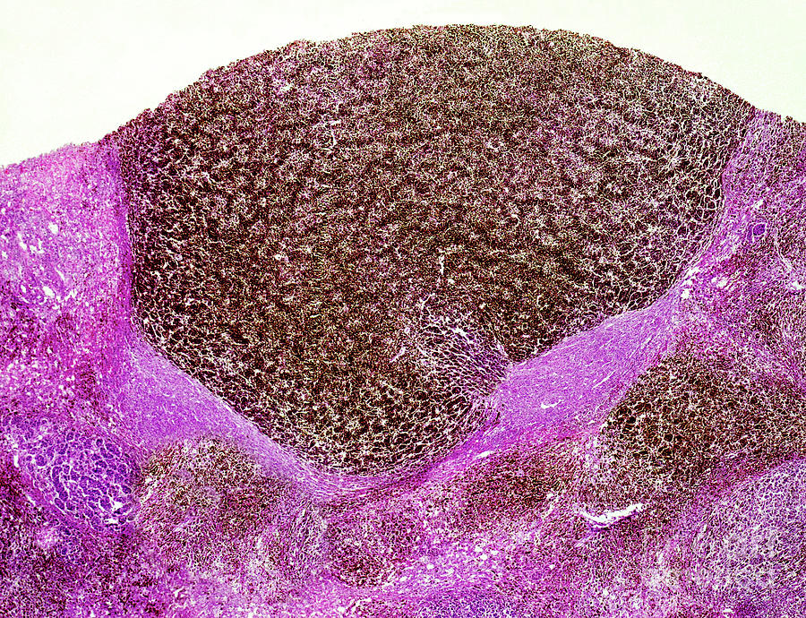 Malignant Melanoma Of The Human Liver Photograph by Nigel Downer/science Photo Library
