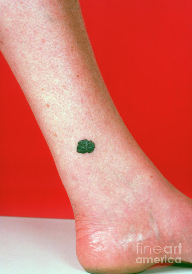 Malignant Melanoma On Lower Leg Photograph by James Stevenson/science Photo Library