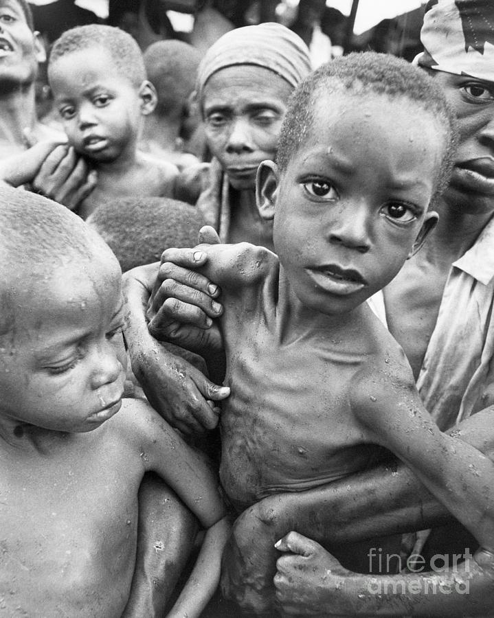 write a descriptive essay about a malnourished child