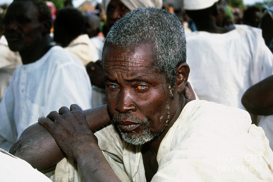 Man With River Blindness Photograph by A. Crump, Tdr, Who/science Photo Library