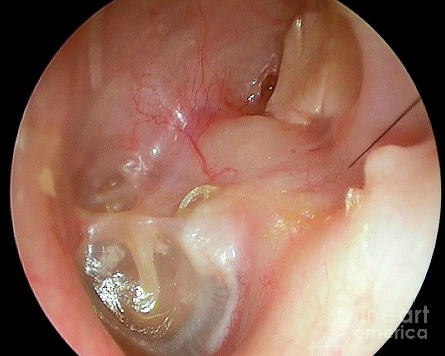 Disease Photograph - Mastoidectomy by Professor Tony Wright, Institute Of Laryngology & Otology/science Photo Library