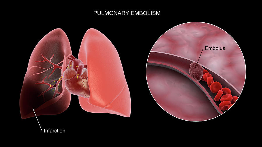 Medical Concept Showing Pulmonary Photograph by Stocktrek Images