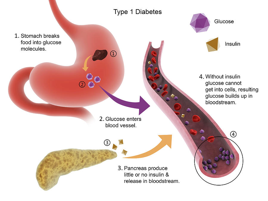 Medical Diagram Of Type 1 Diabetes Photograph by Stocktrek Images