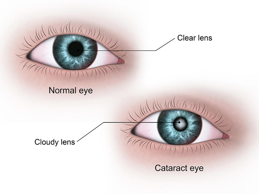 Medical Illustration Of A Cataract Photograph By Stocktrek Images - Pixels