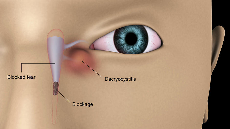 Medical Illustration Of Dacryocystitis Photograph by Stocktrek Images