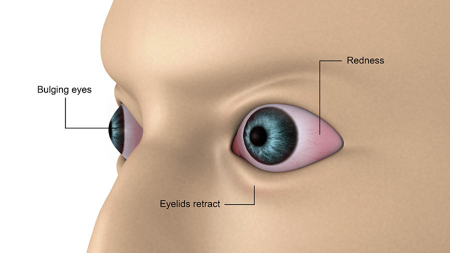 Medical Illustration Of Exophthalmos Photograph by Stocktrek Images