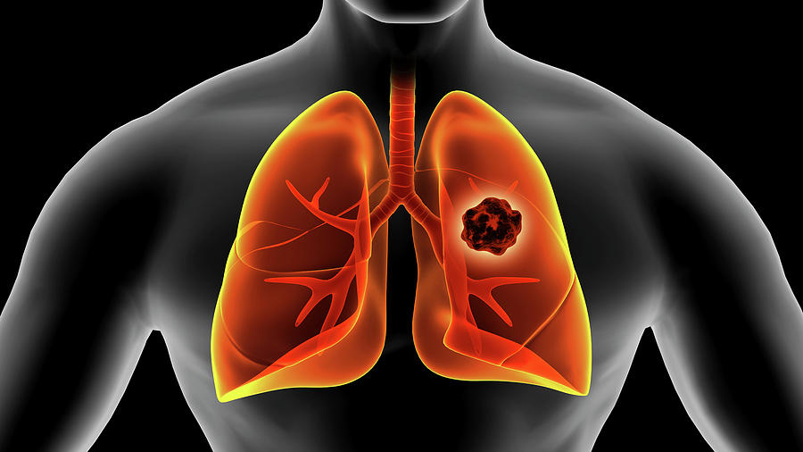 Medical Illustration Of Lung Cancer Photograph By Stocktrek Images | Pixels