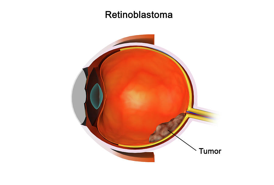 Medical Illustration Of Retinoblastoma Photograph by Stocktrek Images