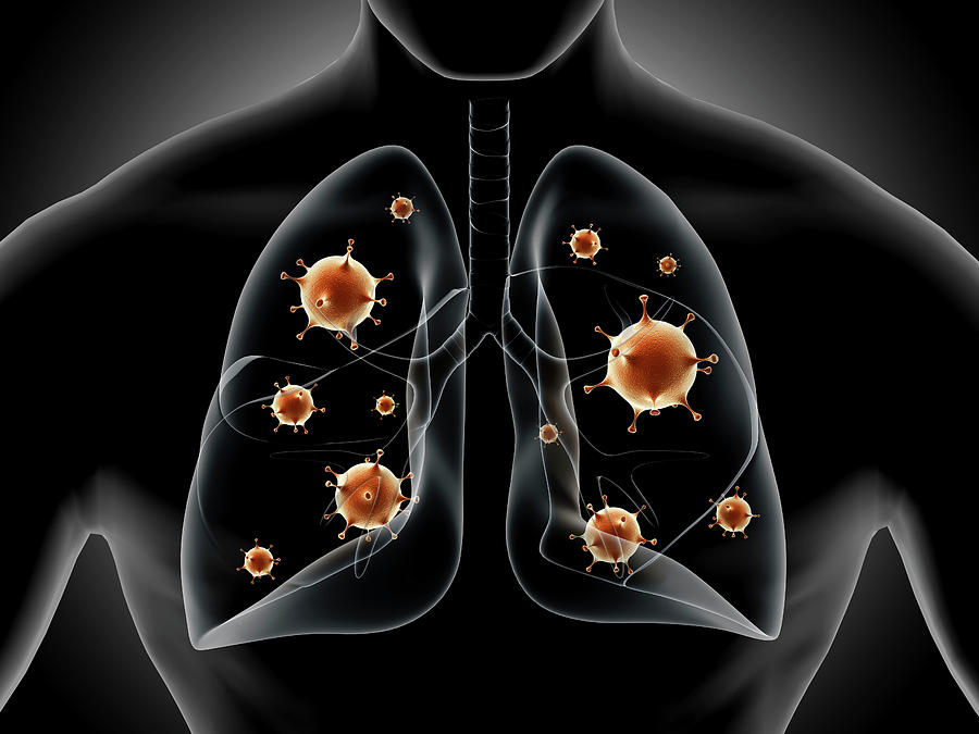 Medical Illustration Showing Pneumonia Photograph by Stocktrek Images ...