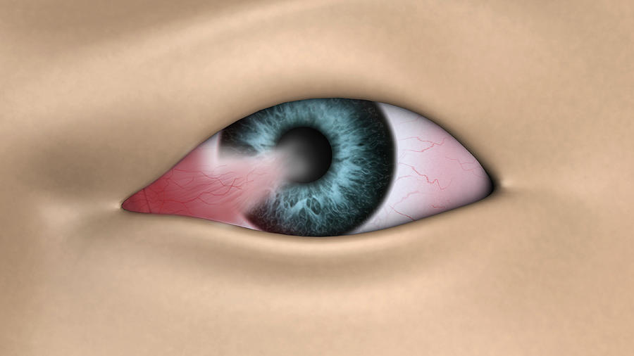Medical Illustration Showing Pterygium Photograph by Stocktrek Images