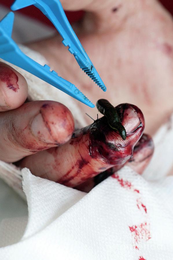 Medicinal Leech On Patients Finger Photograph by Louise Murray/science Photo Library