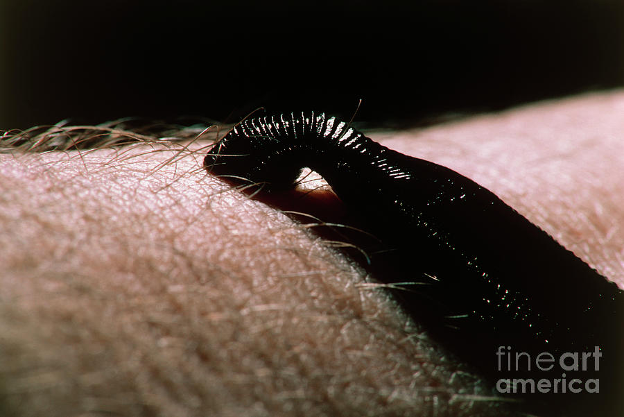 Medicinal Leech Sucking Blood From Human Skin by Geoff Tompkinson/science  Photo Library