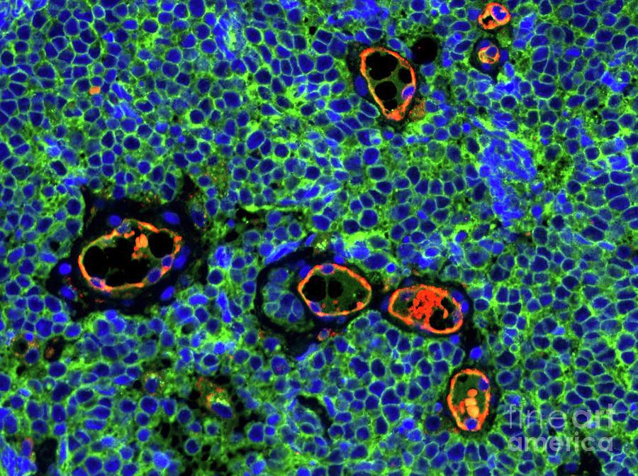 Merkel Cell Carcinoma Photograph by Isaac Brownell, National Institute ...