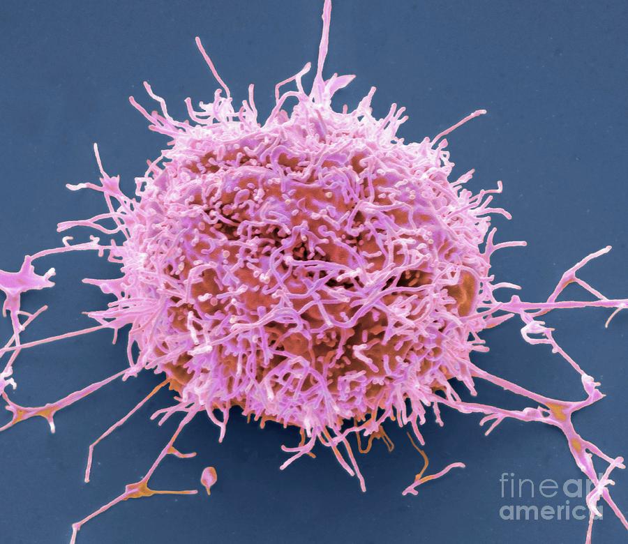 Mesothelioma Cancer Cell Photograph by Steve Gschmeissner/science Photo Library