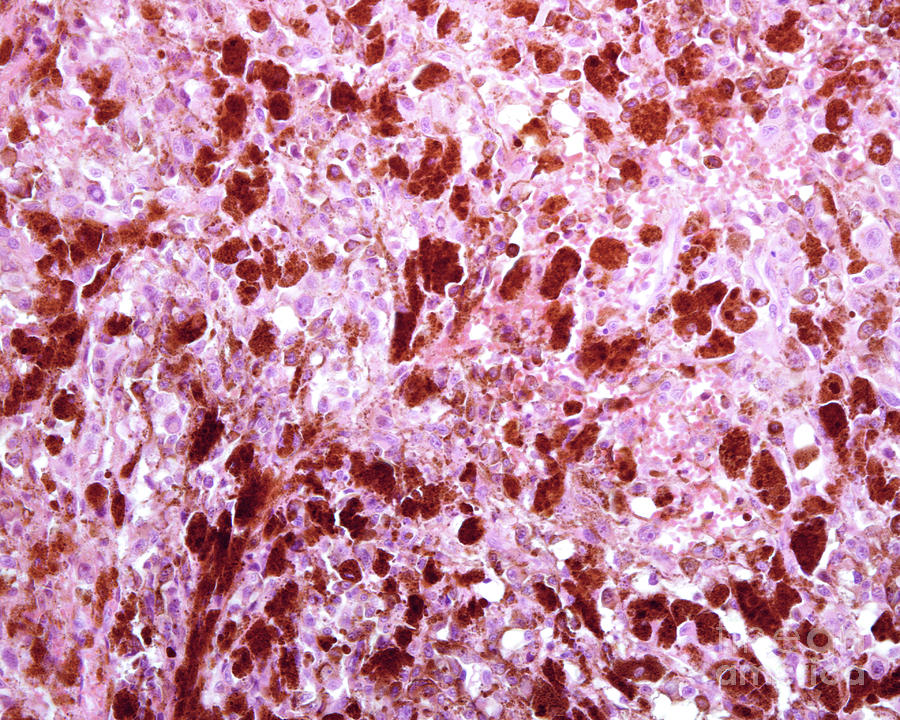Metastasis Of Malignant Melanoma Photograph by Jose Calvo / Science Photo Library