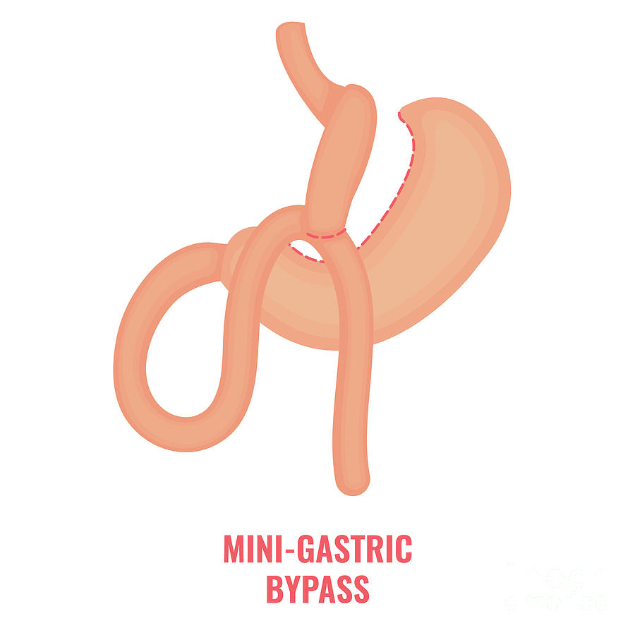 Mini Gastric Bypass Bariatric Surgery Photograph by Art4stock/science Photo Library