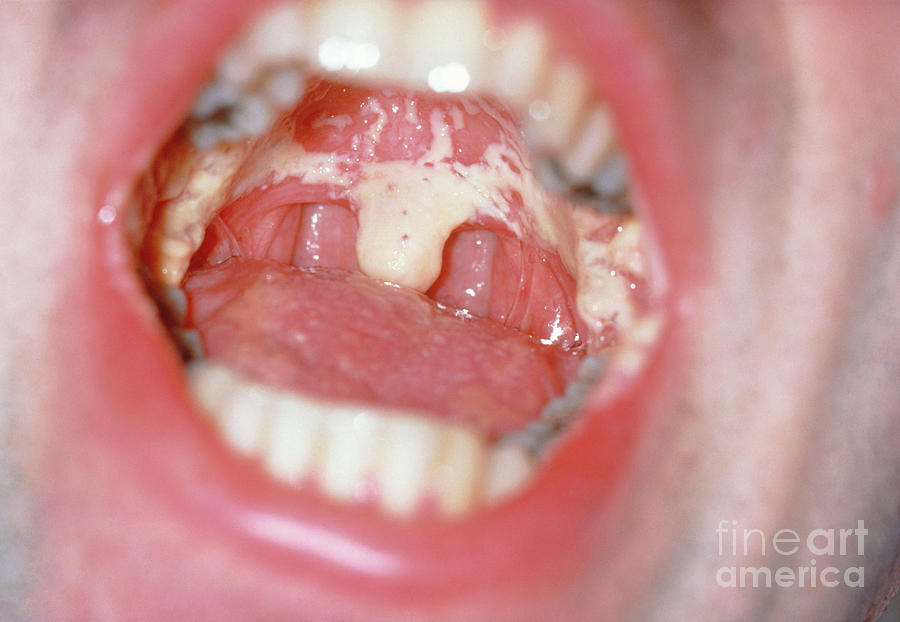 Mouth Of An Aids Patient Showing Oral Candidiasis By Mary's Hospital  Medical School/science Photo Library, Candida In Mouth
