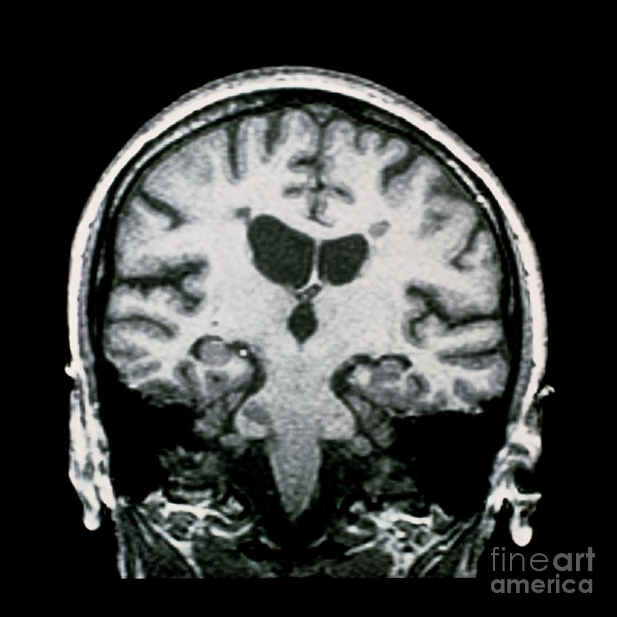 Mri Scan Of Brain With Multiple Sclerosis Photograph By Dr W Crum Dementia Research Group Tim