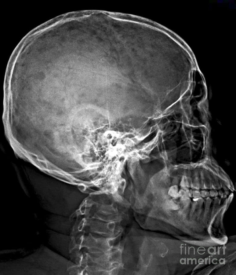 Multiple Myeloma Of The Skull Photograph By Rajaaisya Science Photo Library Pixels