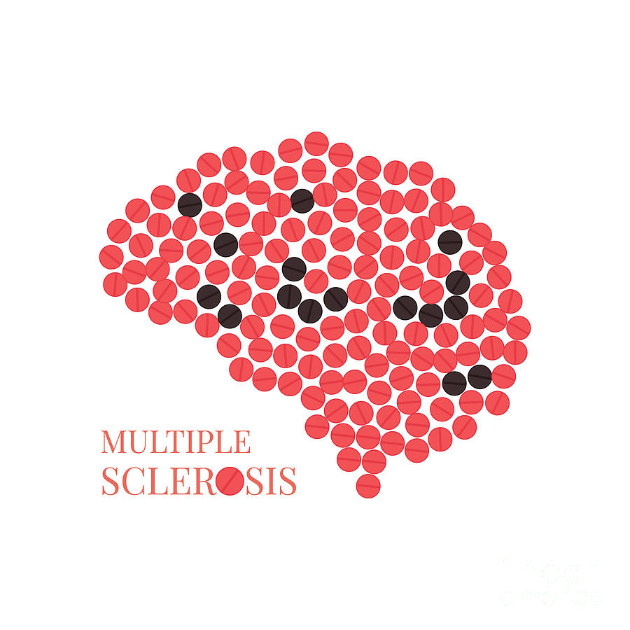 Multiple Sclerosis Photograph by Art4stock/science Photo Library