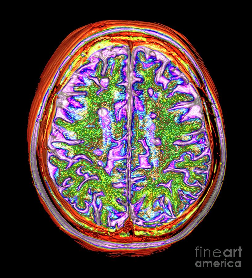 Multiple Sclerosis Photograph by K H Fung/science Photo Library