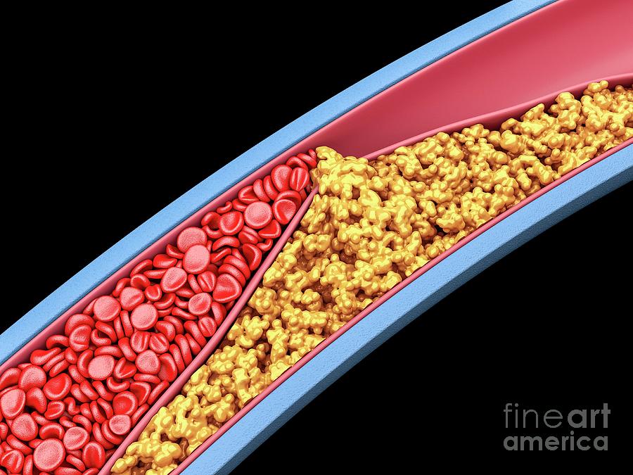 Narrowed Artery Photograph by Maurizio De Angelis/science Photo Library