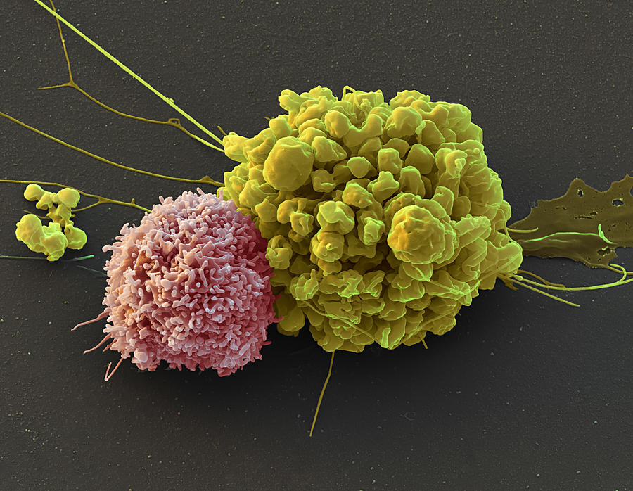 Natural Killer Cell On Ependymoma Photograph by Eye of Science