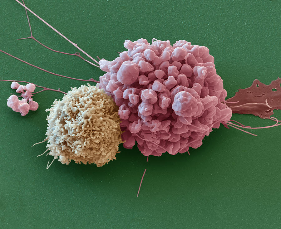 Natural Killer Cell On Ependymoma Photograph by Meckes/ottawa