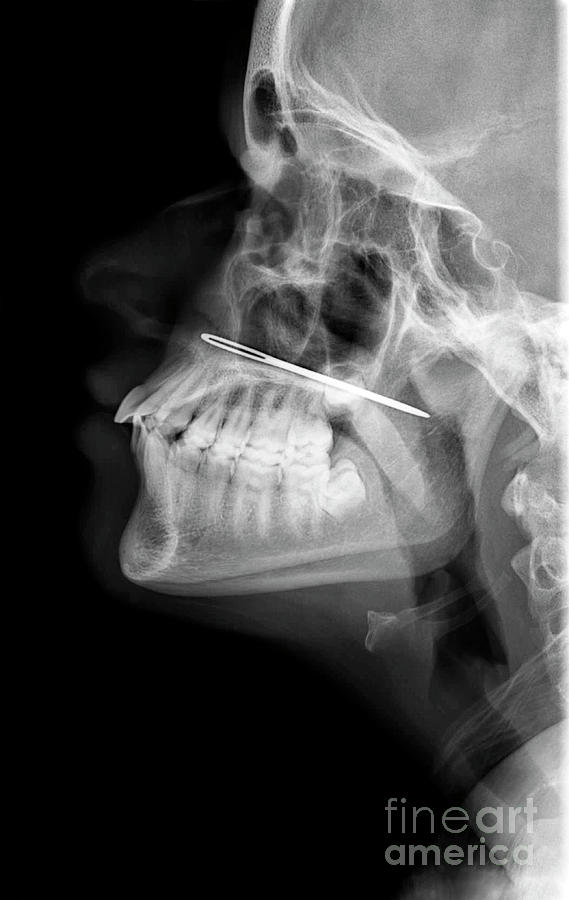 Needle Nose Injury Photograph by Science Photo Library Fine Art America
