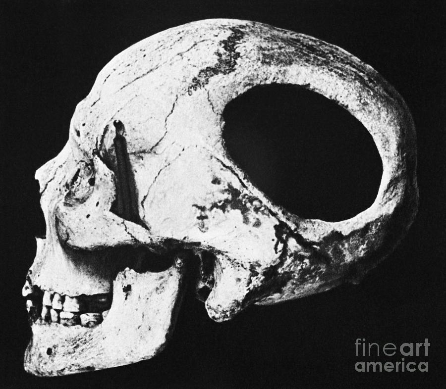 Neolithic Skull With Hole Photograph by Bettmann