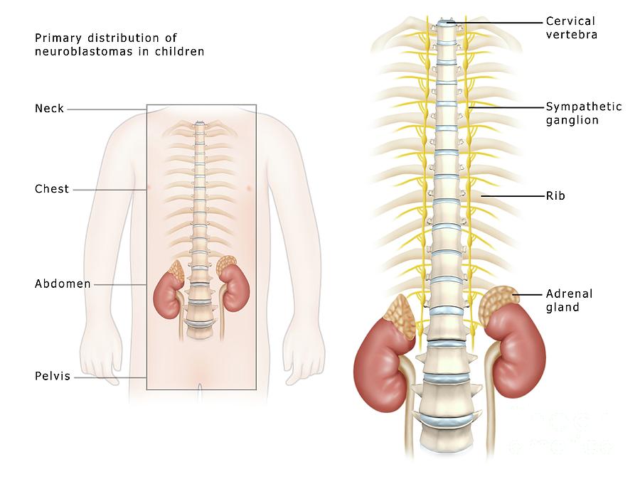 Neuroblastoma Photograph - Neuroblastoma Distribution In Children by Maurizio De Angelis/science Photo Library Neuroblastoma Photograph - Neuroblastoma Distribution In Children by Maurizio De Angelis/science Photo Library