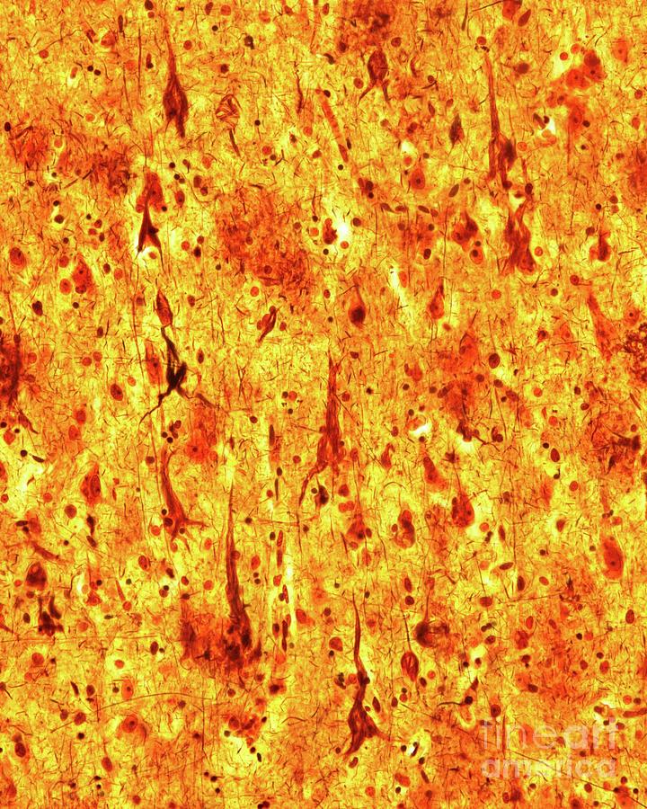 Neurofibrillary Tangles Photograph by Jose Calvo / Science Photo Library
