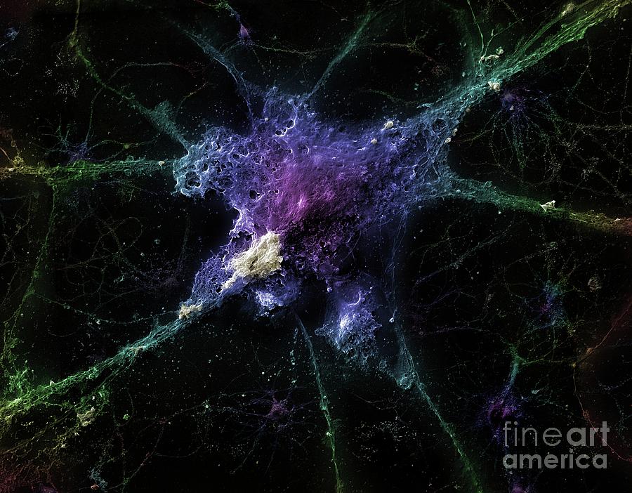 Neuron With Amyloid Beta Peptide Photograph by Linnea Rundgren/linear Imaging/science Photo Library