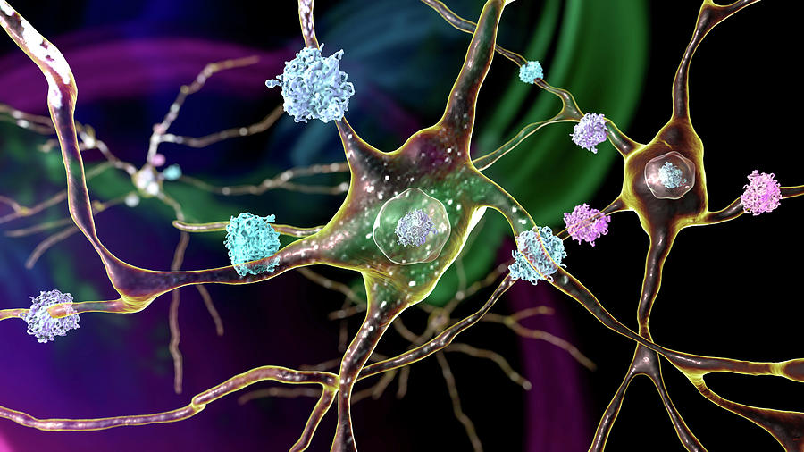 Neuronal Inclusions In Huntingtons Photograph by Kateryna Kon
