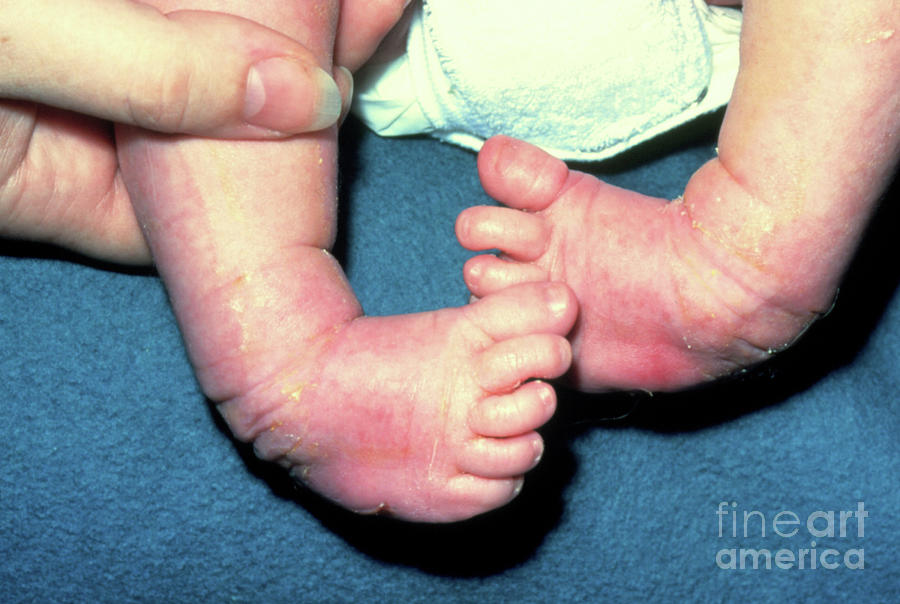 Newborn Baby With Club Foot Photograph by Jim Stevenson/science Photo Library