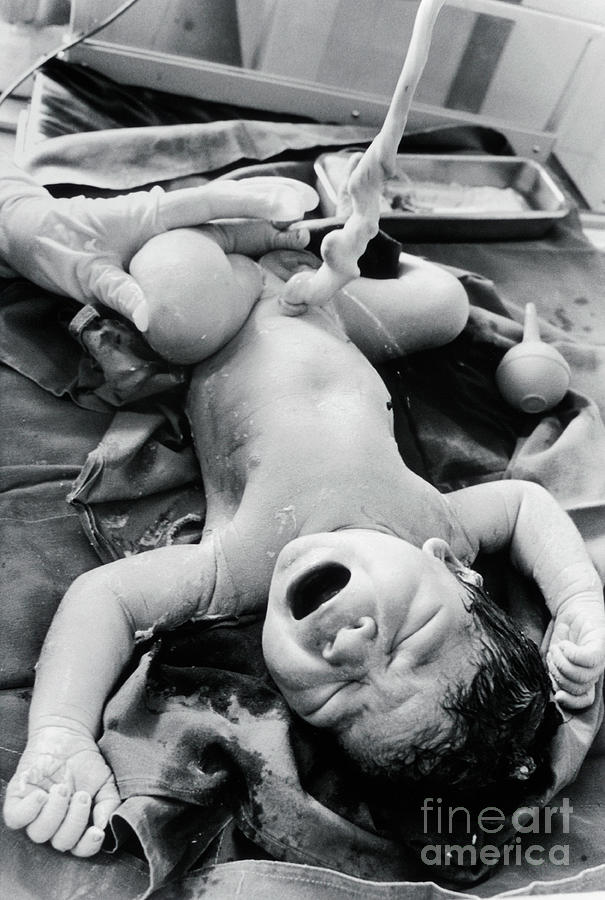 Newborn Baby With Umbilical Cord Still Attached Photograph by Henny Allis/science Photo Library