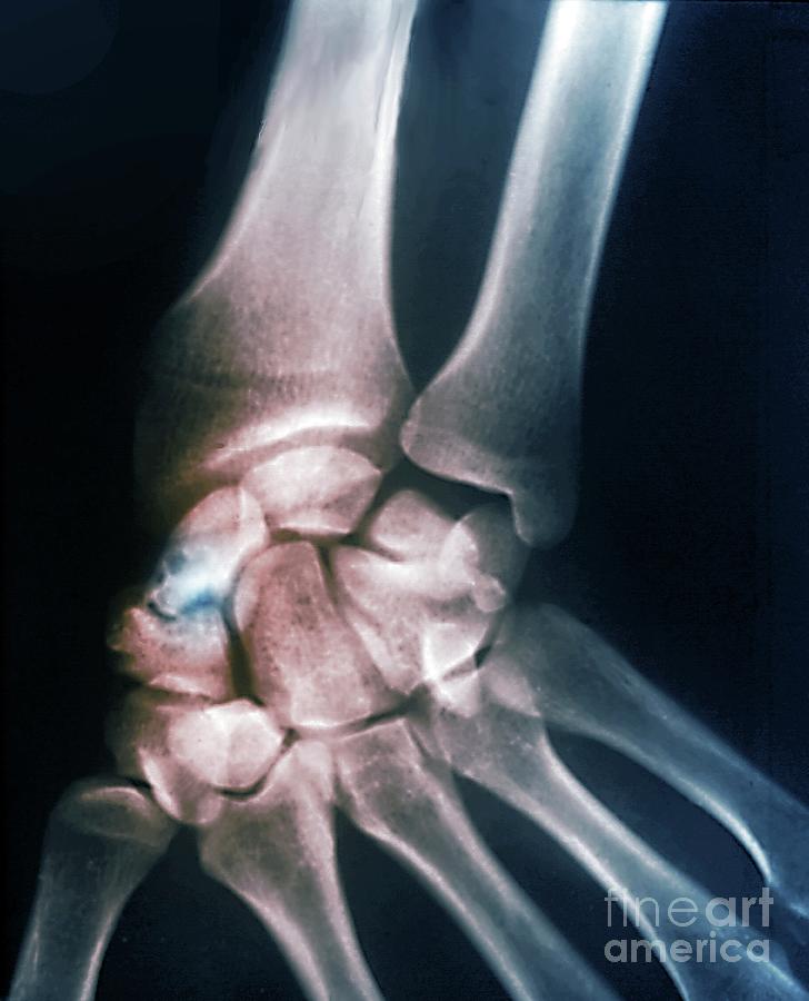 Non Healed Scaphoid Fracture Photograph By Zephyr Science Photo Library My Xxx Hot Girl 4320