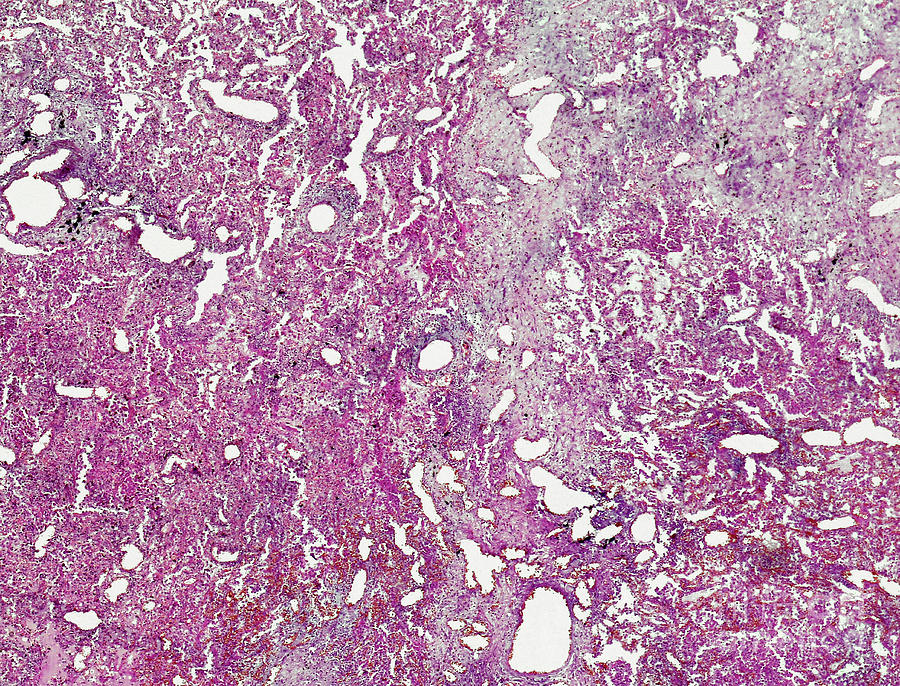 Non-specific Interstitial Pneumonia by Nigel Downer/science Photo Library