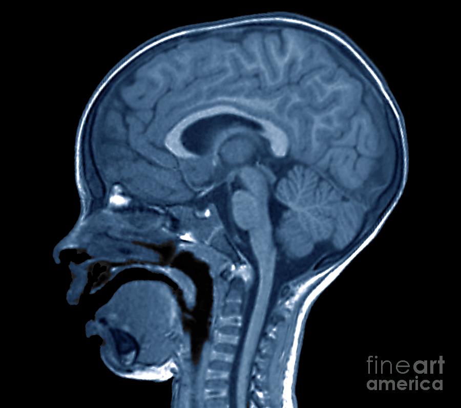 Normal Brain Of A Child Photograph by Zephyr/science Photo Library